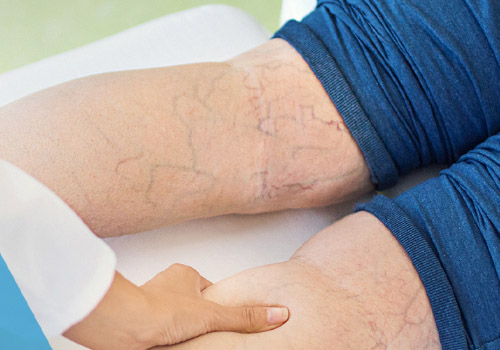 Varicose Vein Treatment